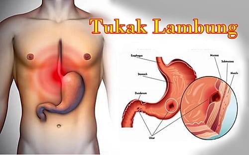 Penyebab Gejala Dan Obat Tukak Lambung Alami