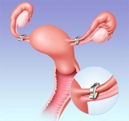 Thắt ống dẫn trứng là gì: 12 Thông tin quan trọng không...