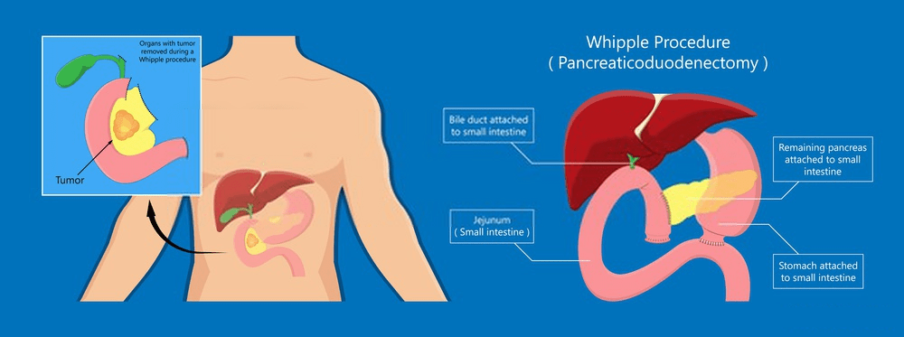 What Is Whipple Procedure? What Are Its Effects? - whipple procedure ...