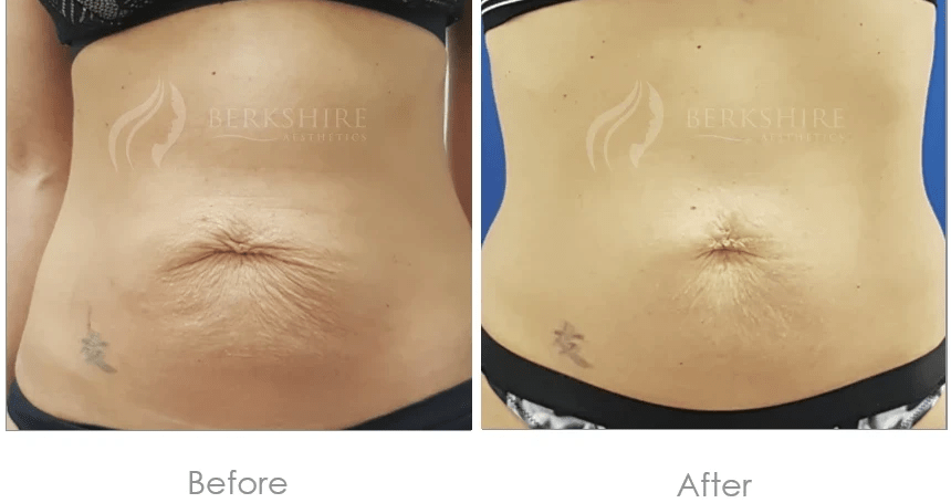 Skin Tightening