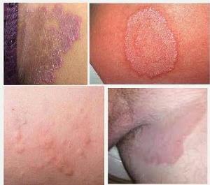 Penyebab Anus Dubur Gatal Dan Cara Mengatasinya Honestdocs