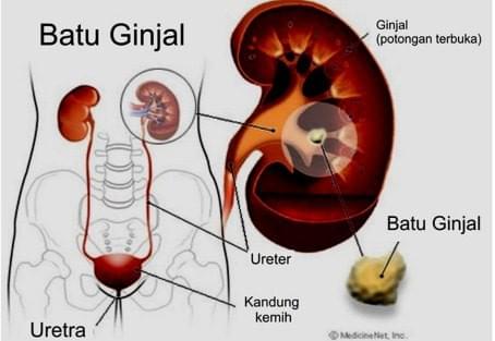 Penyebab Penyakit Lambung Menurut Ustad Danu Hidup Sehat