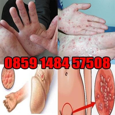 Obat Penyakit Sipilis Gejala Sipilis Ciri Ciri Sipilis Sipilis Pria Penyakit Sipilis Obat Sipilis
