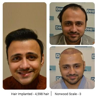 Dhi Hair Transplant Journey Of A Young Business Owner Nikhil is superb, no words for him. dhi hair transplant journey of a young