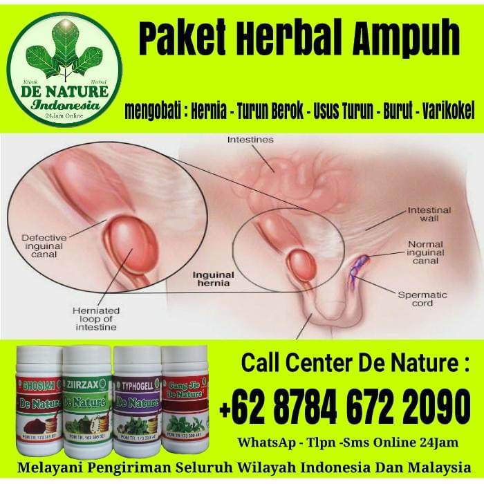 Inilah Solusi Mengatasi Paling Aman Penyakit Hernia Tu