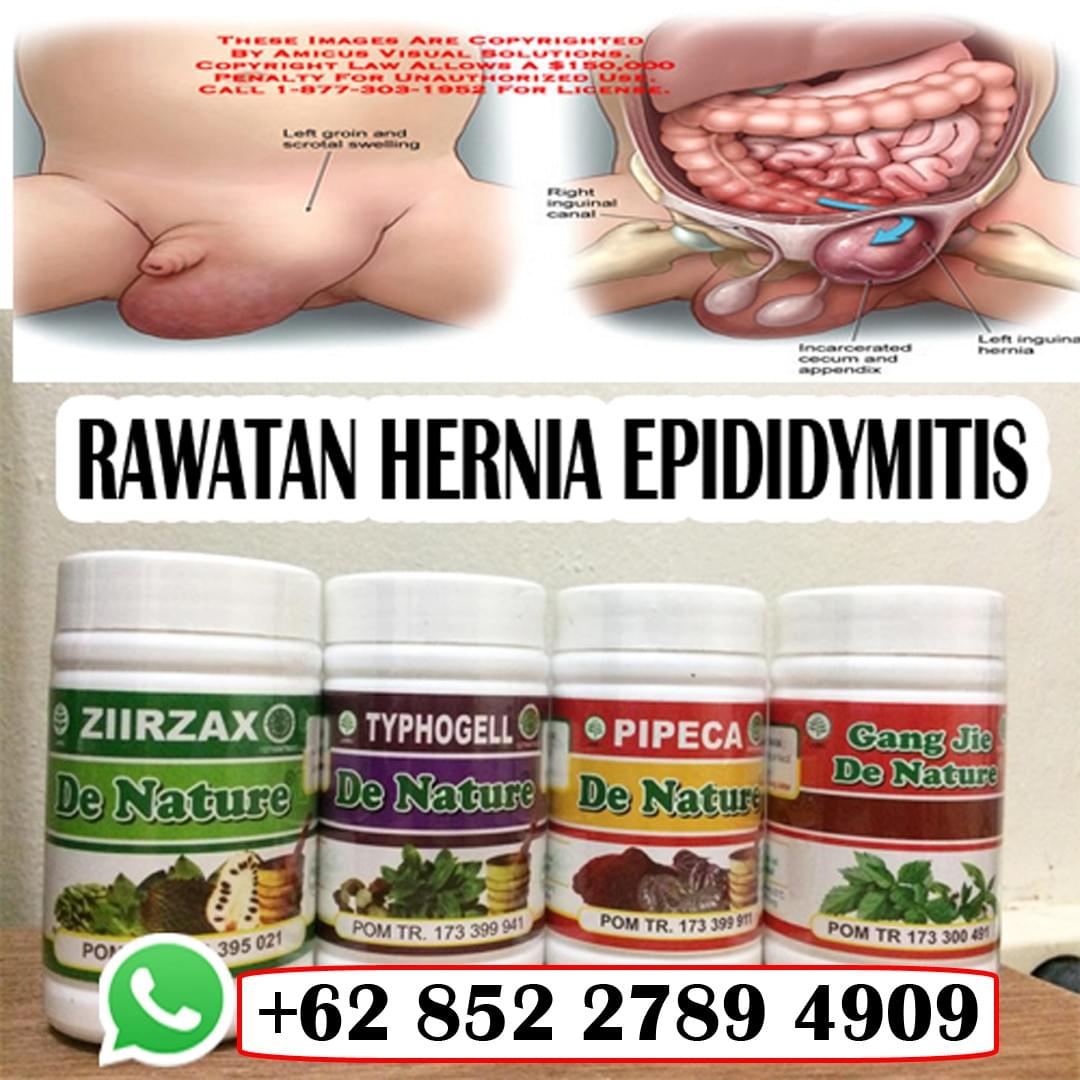 Cara Atasi Sakit Uluran Medu Angin Herniaubat Dan Rawa
