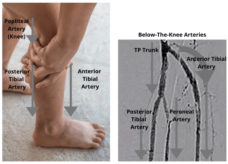 PAD Treatment The Way To My Heart