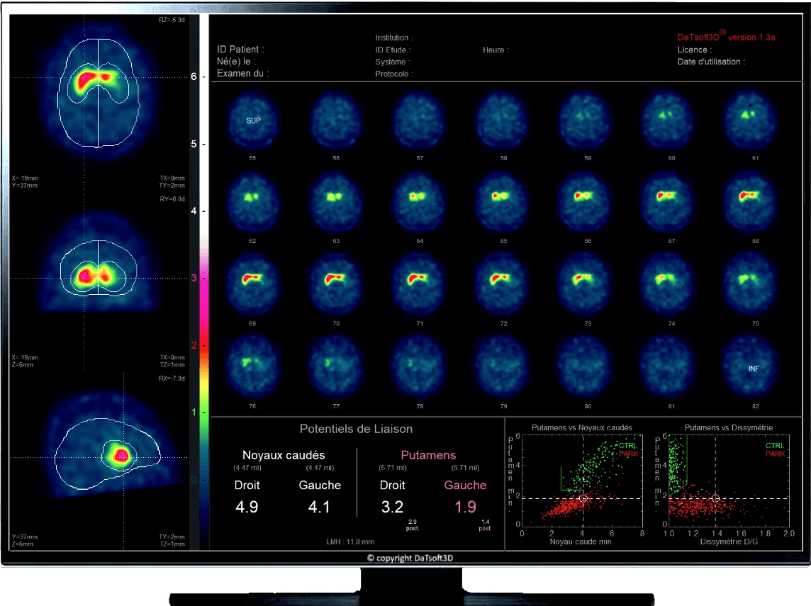 DaTscan quantification software