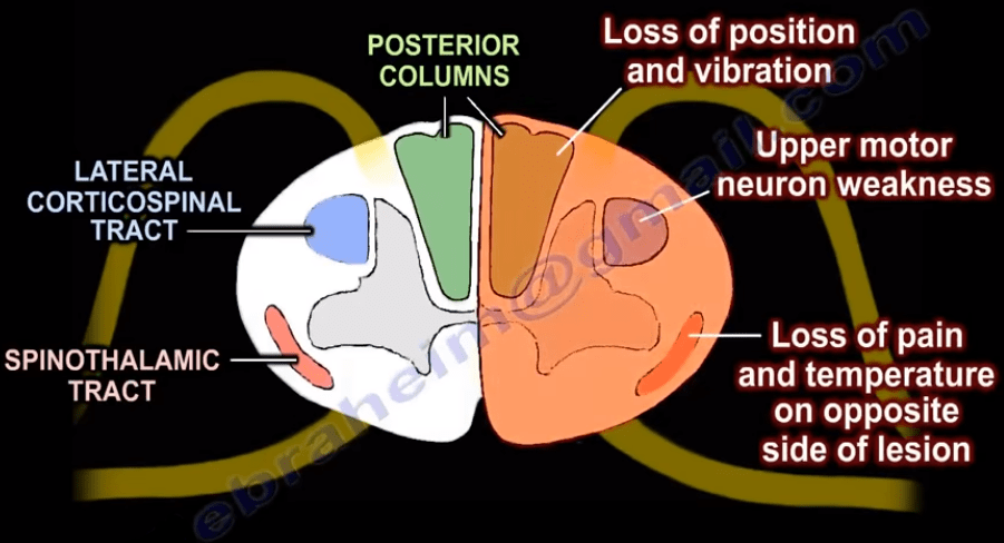 Brown Sequard Syndrome Healthcare Spine Injury Spinal Cord Medicine Nabil Ebraheim Brown Sequard Syndrome Healthcare Spine Injury Spinal Cord Medicine Nabil Ebraheim
