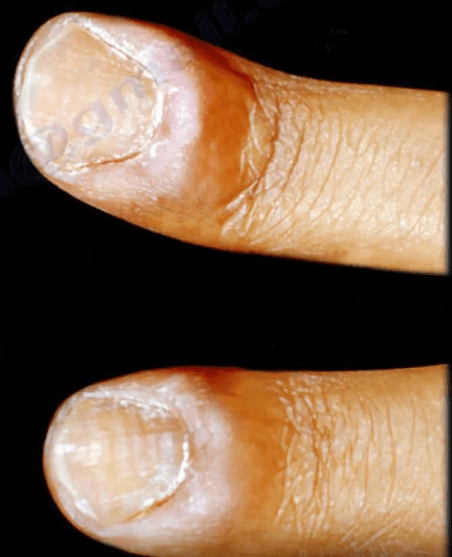 Paronychia skin chemotherapy finger infection toxicities related swelling Paronychia - Orthopedics Nail Infections medicine Healthcare