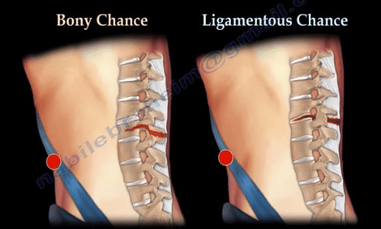 Chance Fractures of the Spine - Healthcare Fractures car accidents