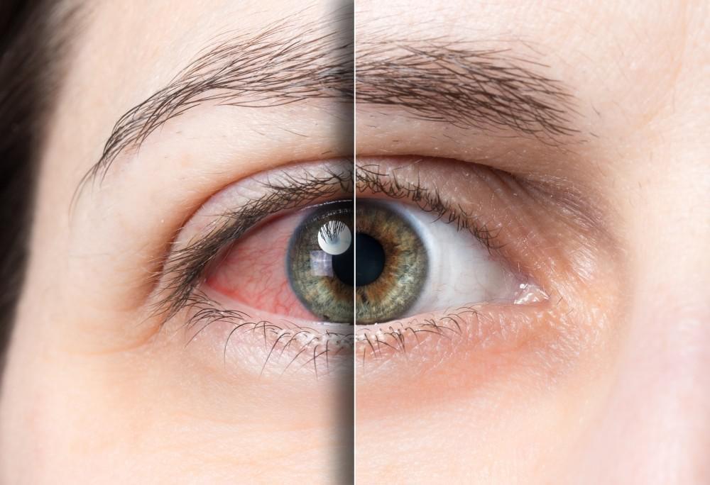 Melipona Honey For The Eyes 13 Benefits That Will Change Your Way Of Seeing It Melipona Honey Cataracts