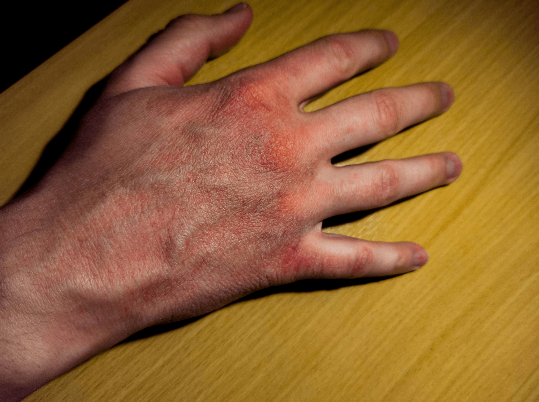 皮膚癢｜如何識別和治療？濕疹、蕁麻疹、乾癬、糖尿病都有可能？一文帶你了解皮膚癢的識別方法、潛在風險及治療｜淺顯易懂的行醫筆記｜療寮診所．板橋江子翠｜家醫科診所．健保一般科